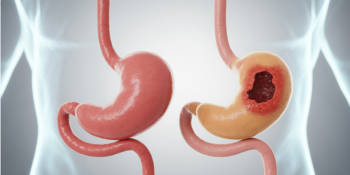 Como Saber se Minha Dor de Estômago É Úlcera?